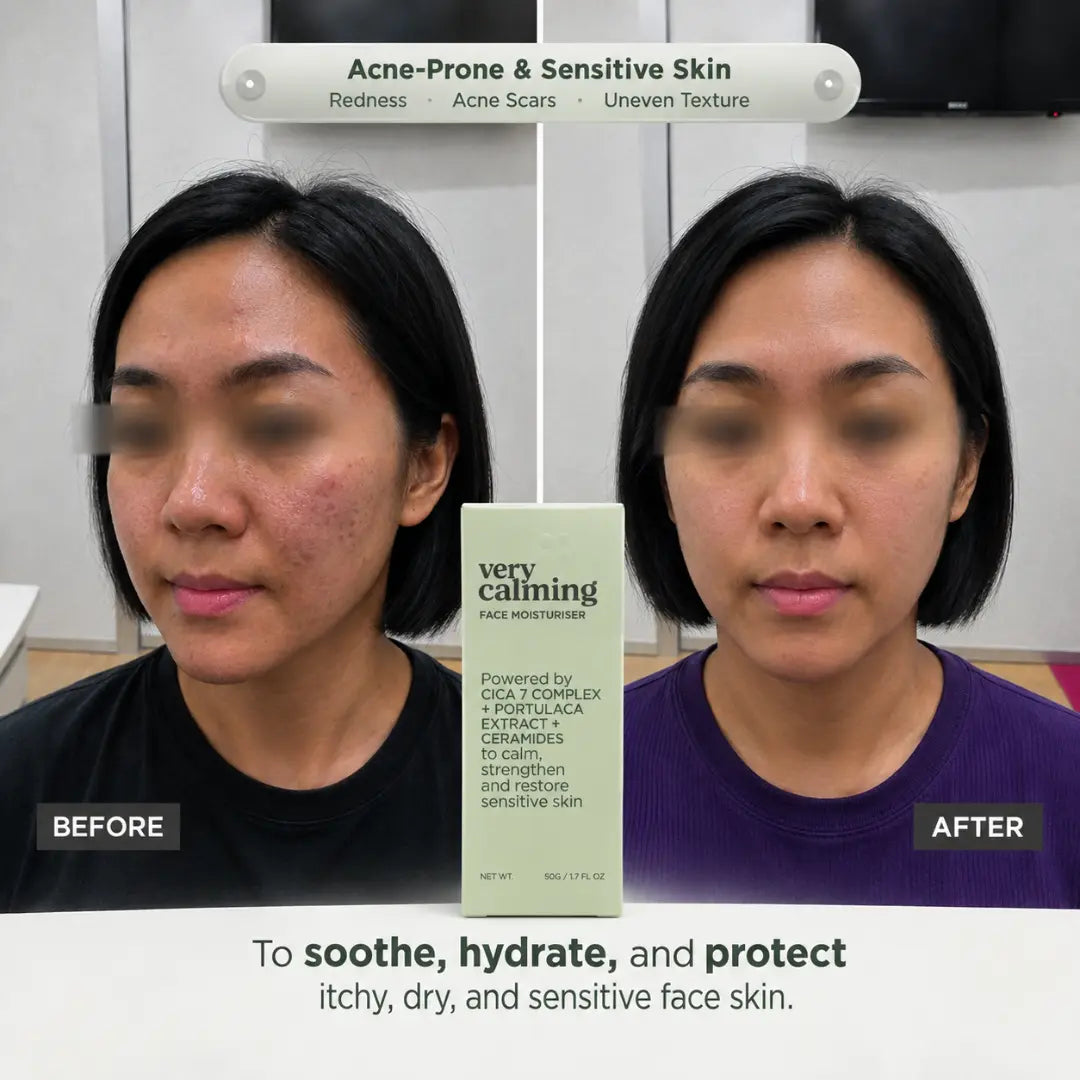 Before-and-after comparison of acne-prone, sensitive facial skin, featuring dr.SK Very Calming Face Moisturiser for soothing and hydration.